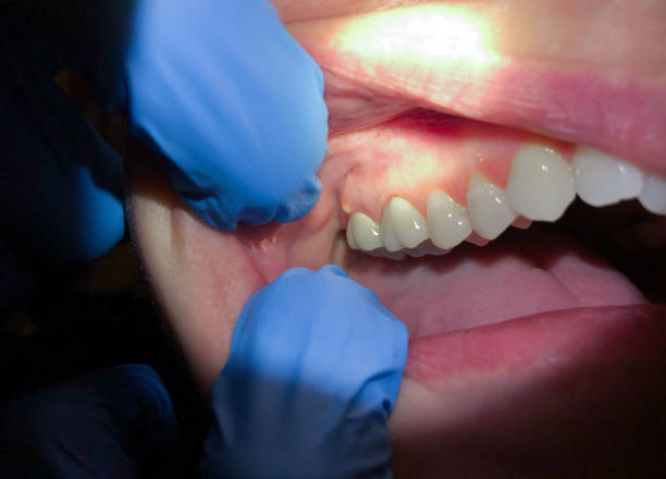 Best Emergency Wisdom Teeth Removal in Girard, KS